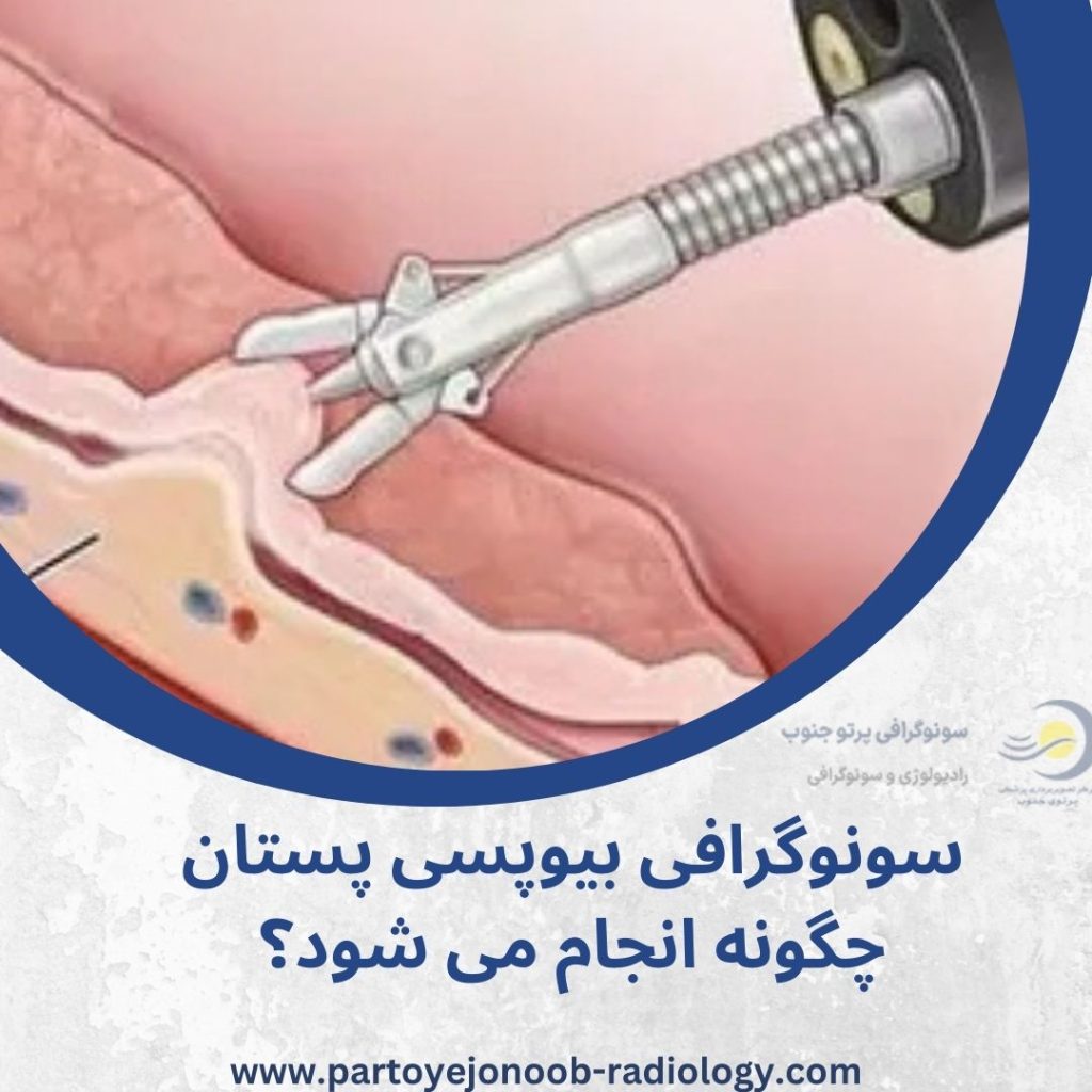 سونوگرافی بیوپسی پستان
