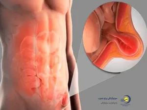 سونوگرافی فتق کشاله ران