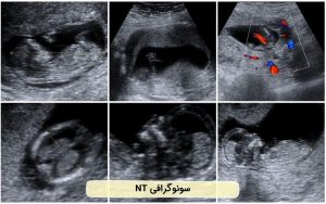 سونوگرافی NT