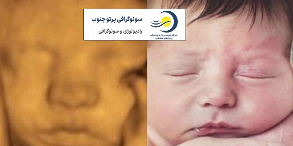 سونوگرافی سه بعدی