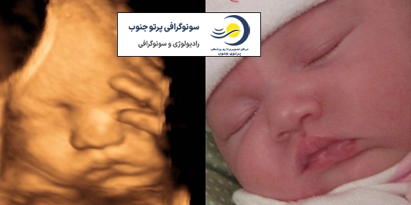 سونوگرافی سه بعدی