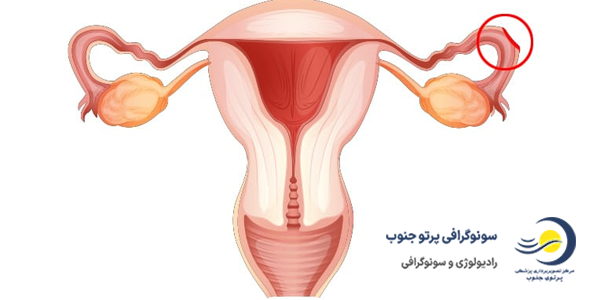 سونوگرافی بارداری خارج رحمی