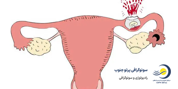 سونوگرافی بارداری خارج رحمی